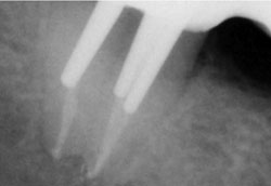 Лазерная стоматология - Рентгеновский снимок 47-го зуба через через 2 года после ФАД
